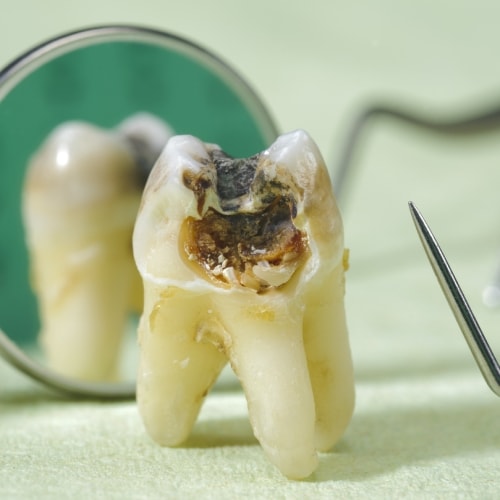 Reassessing caries risk in the post pandemic world